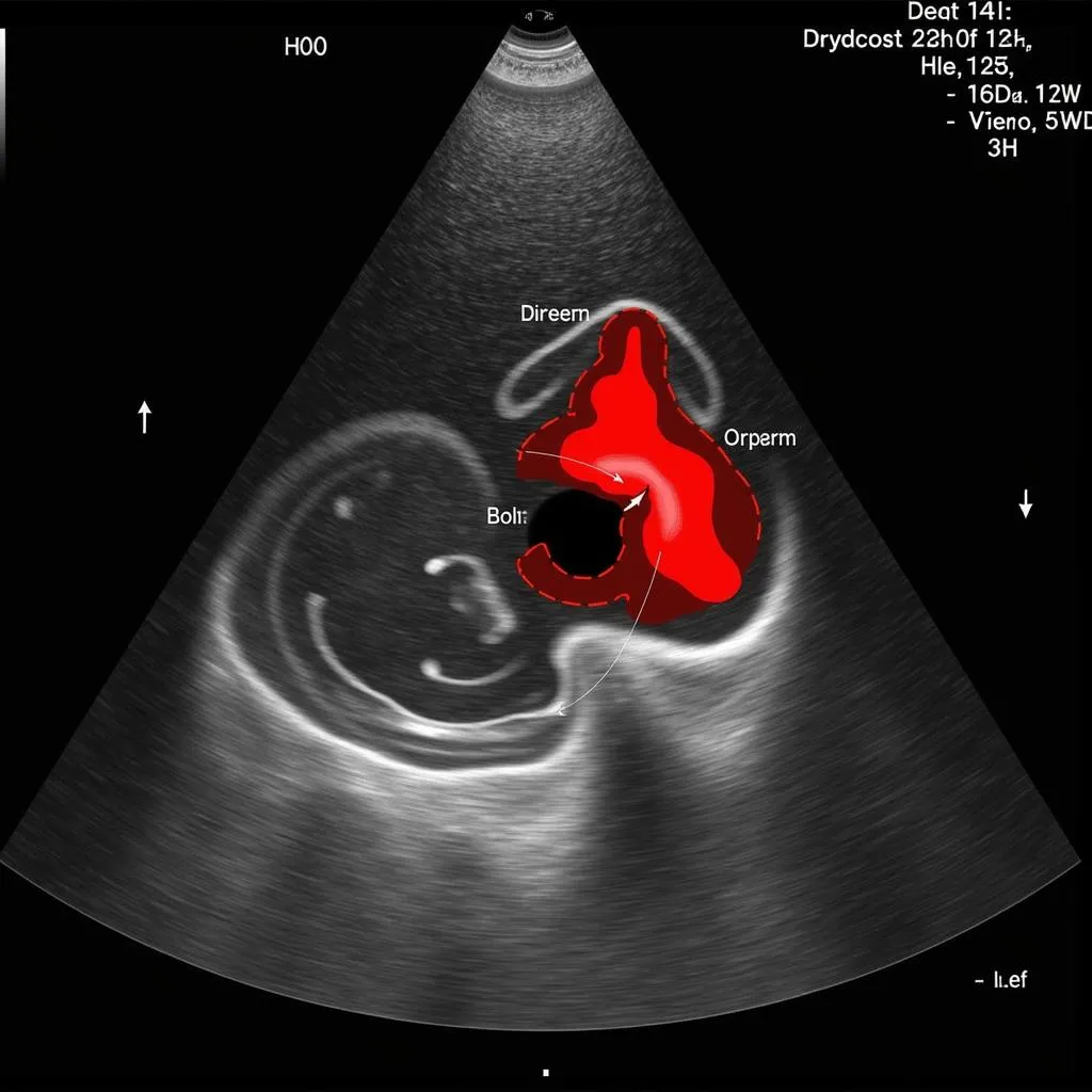 Echocardiogram Showing Aortic Regurgitation Jet