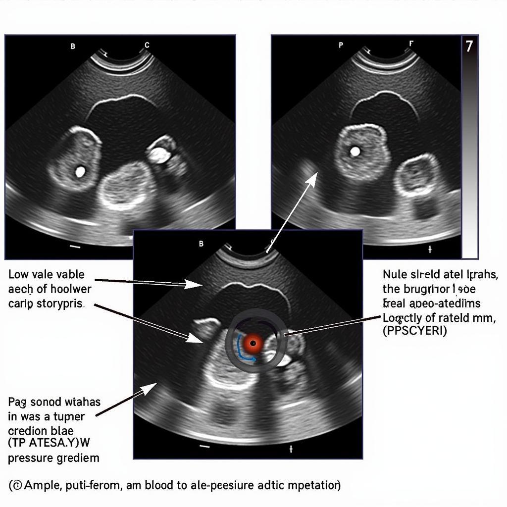 Echocardiogram showing Low Flow Low Gradient Aortic Stenosis