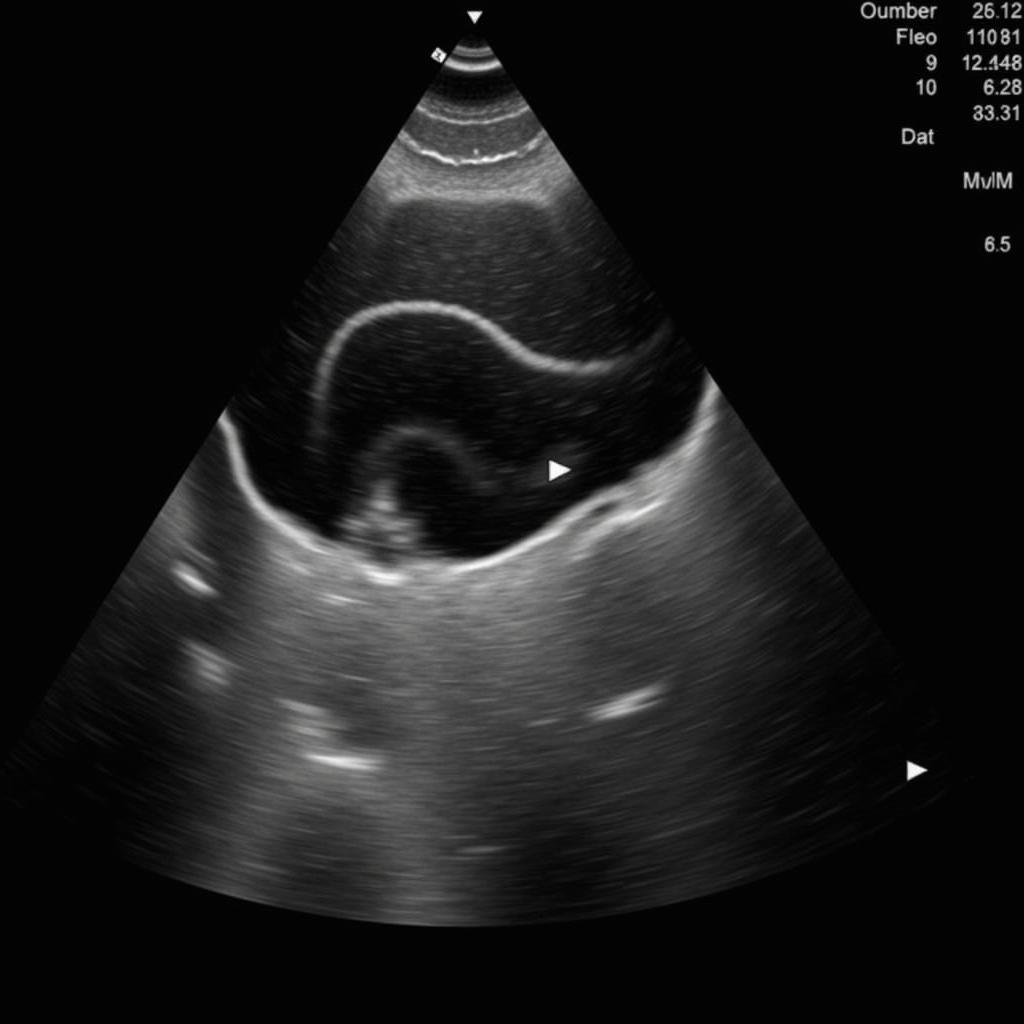 Echocardiogram image highlighting aortic paravalvular leak