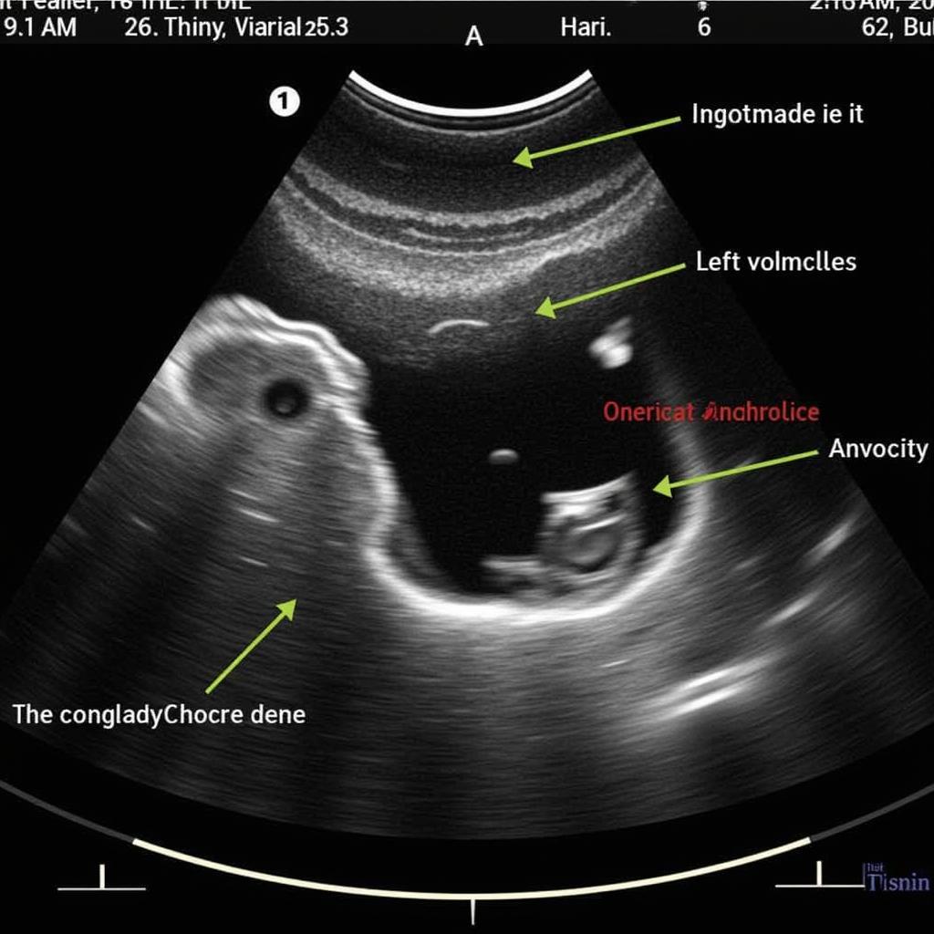 Echocardiography of Aortic Regurgitation