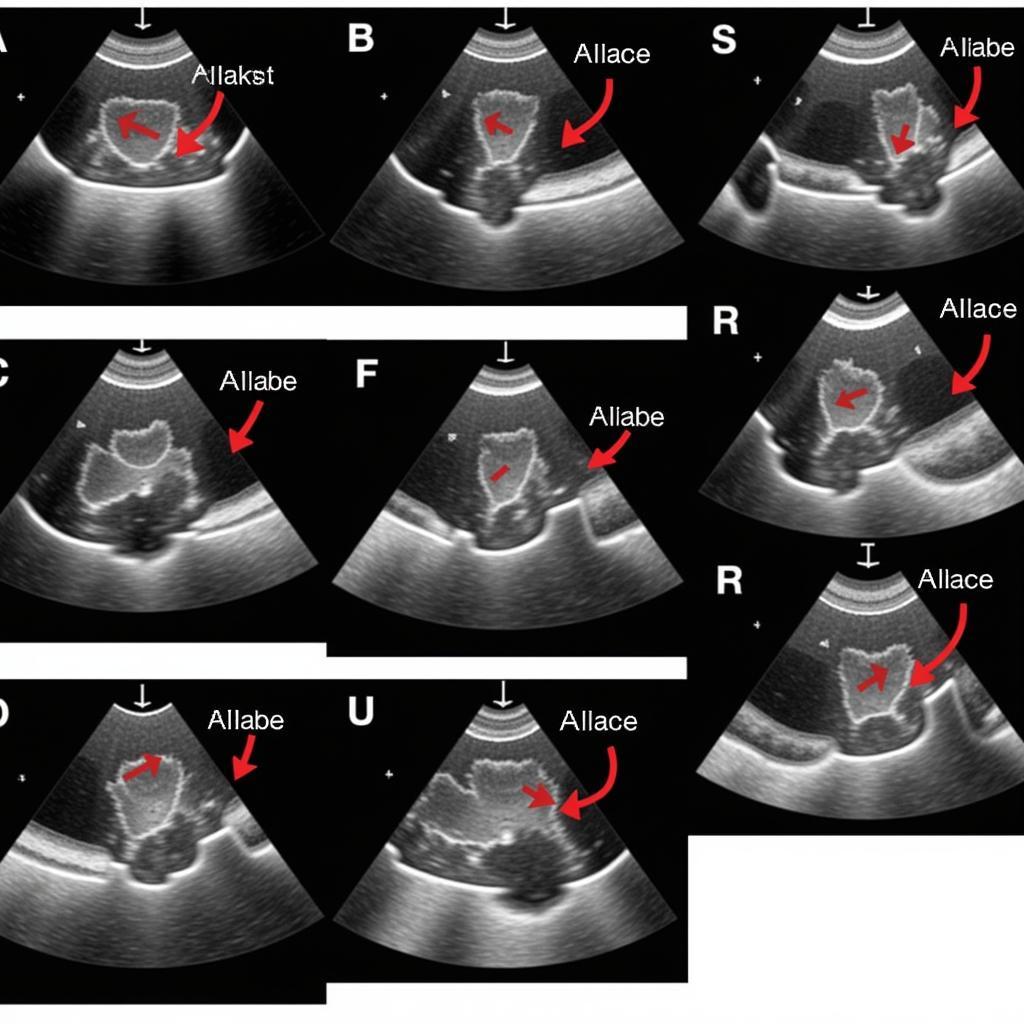 Image Interpretation in Stress Echocardiography