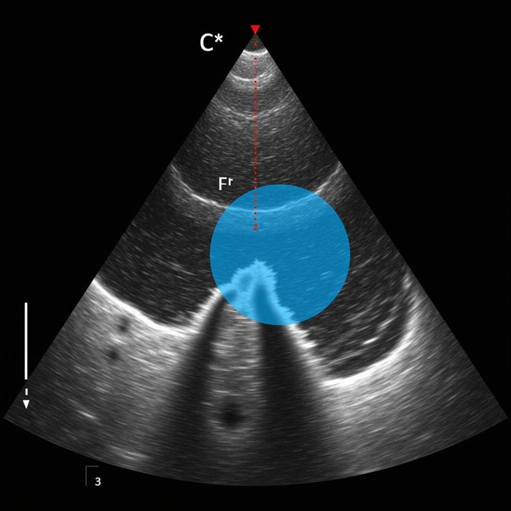 Color Doppler Jet Area in Mitral Regurgitation