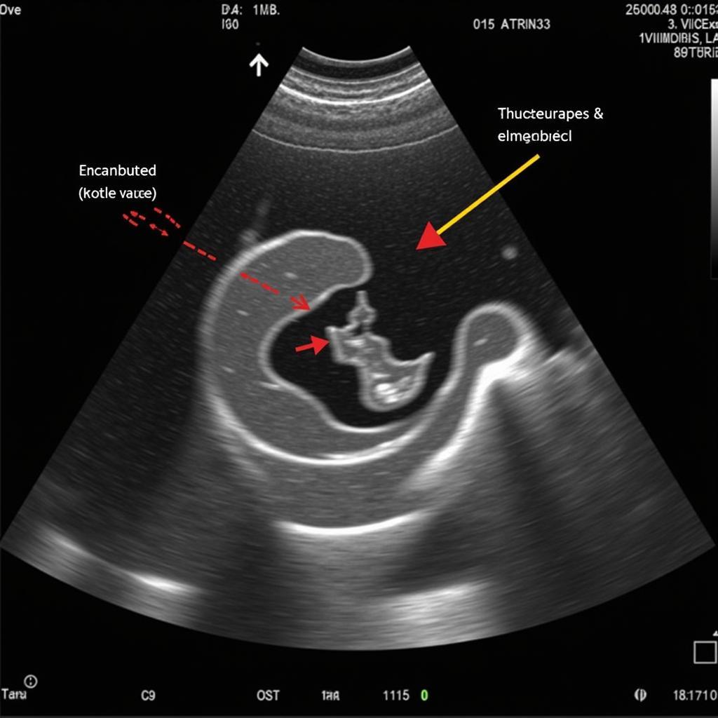 Echocardiogram Showing Ase Mitral Valve Prolapse