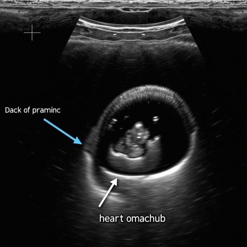 Echocardiography Image of Pericardial Effusion