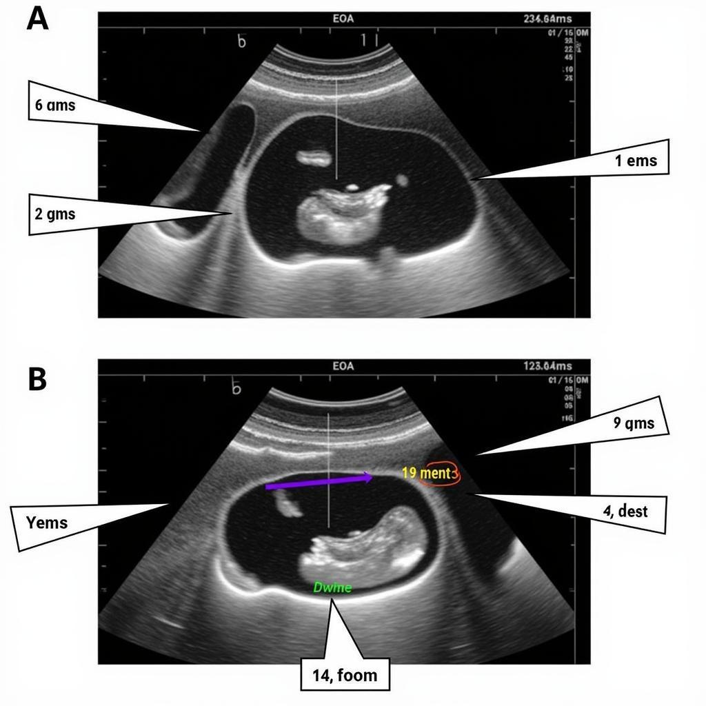 Echocardiography image showing PPM