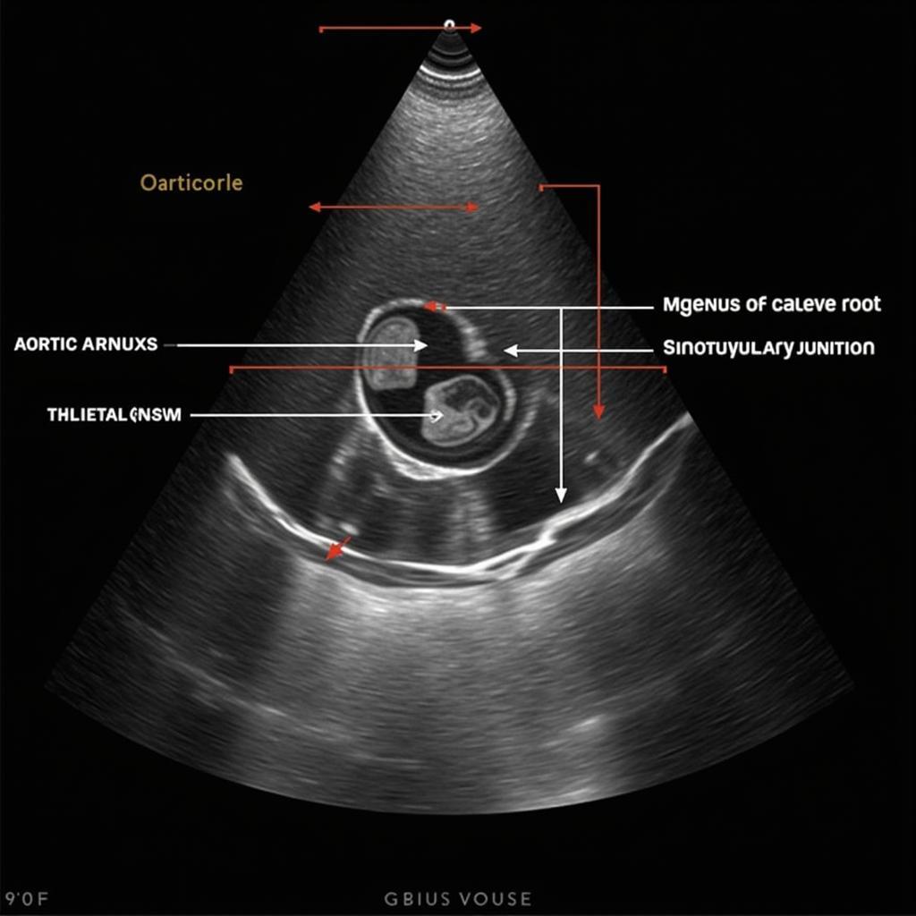 Echocardiography Aortic Root Measurement