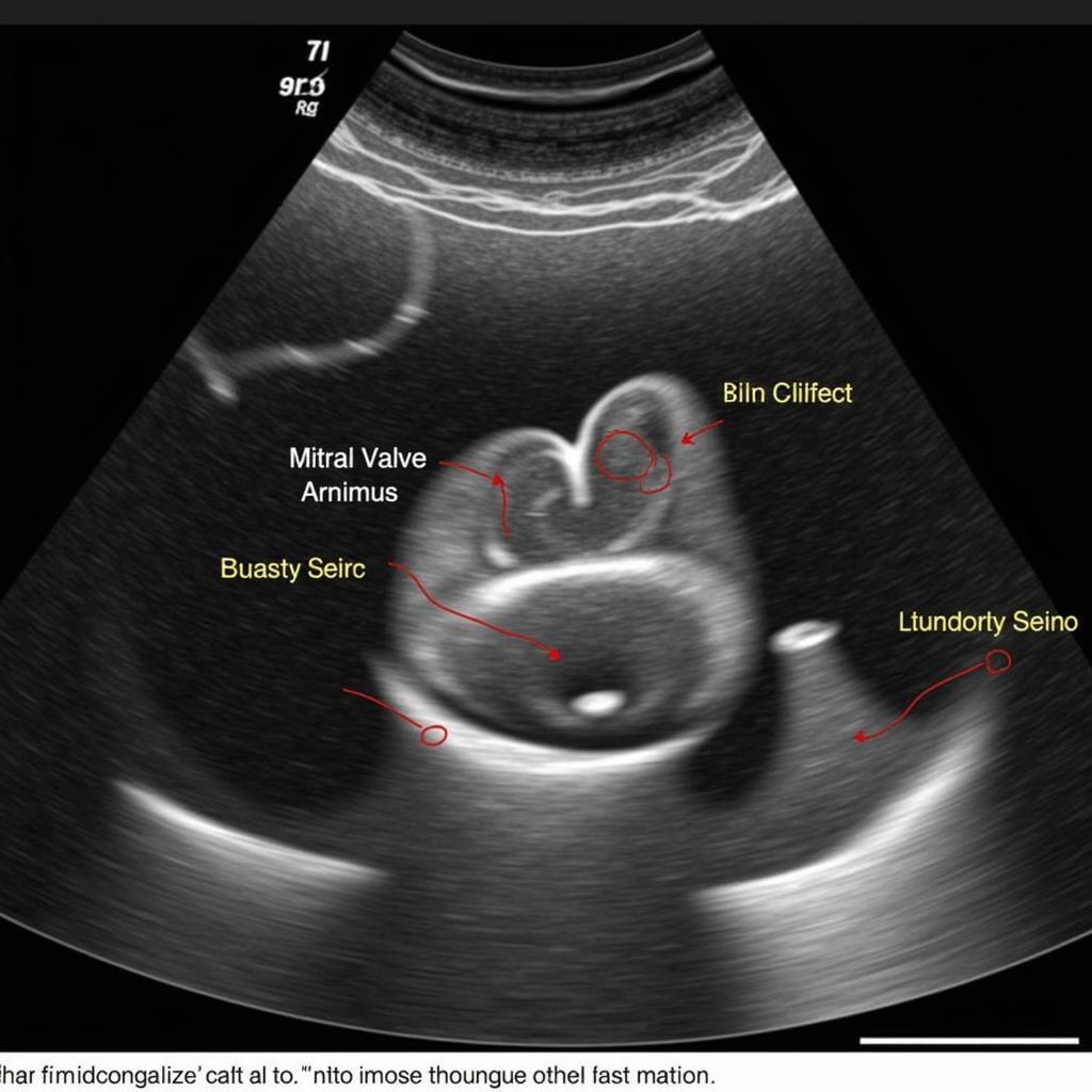 Echocardiography Measurement of Mitral Annulus