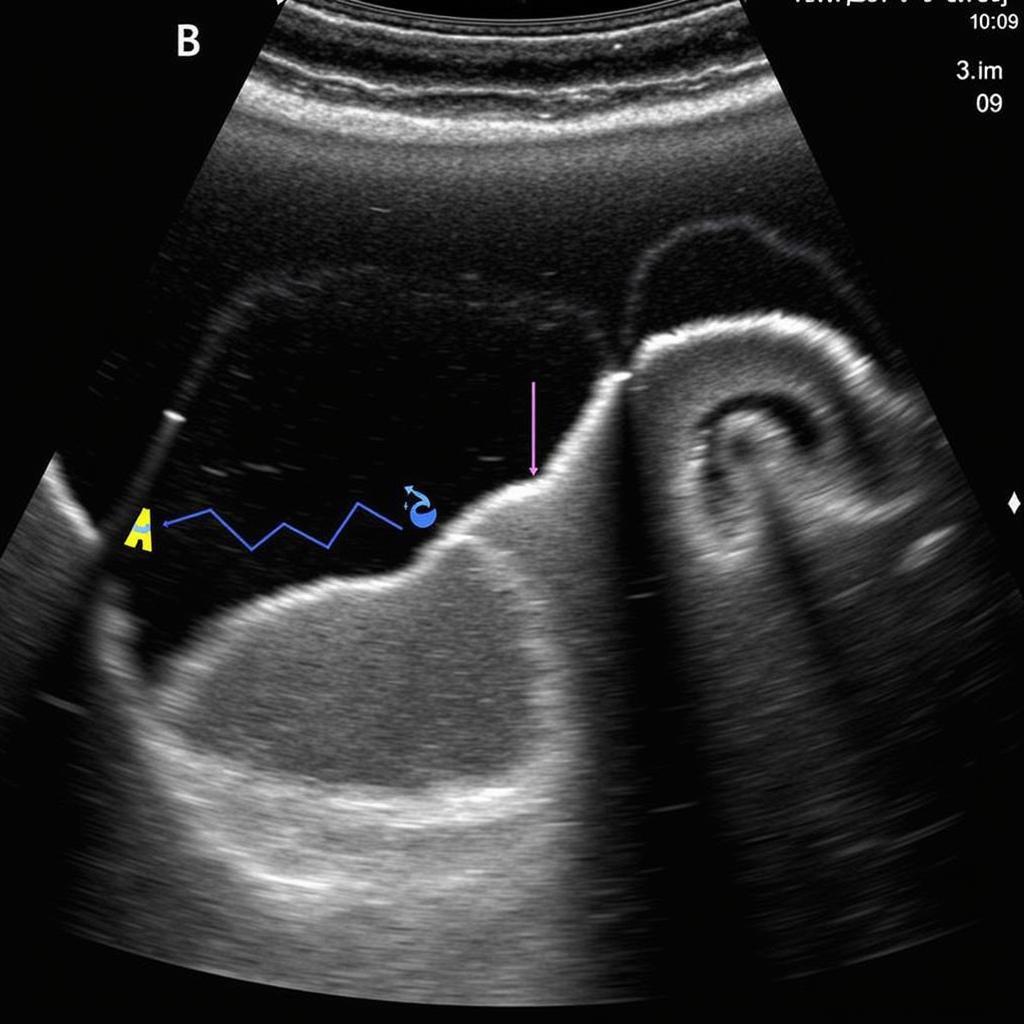 ASE Echo Assessment of Diastolic Function in HCM