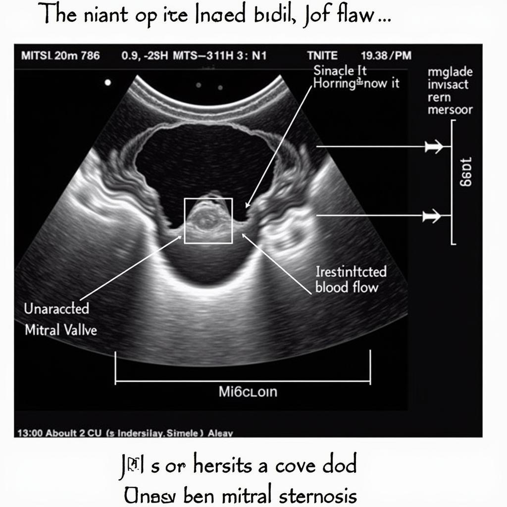 ASE Echo Mitral Stenosis Diagnosis