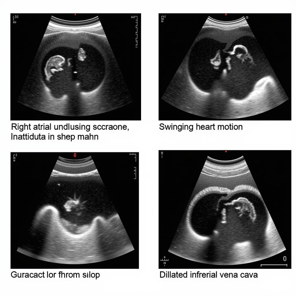 Echocardiographic Signs of Cardiac Tamponade