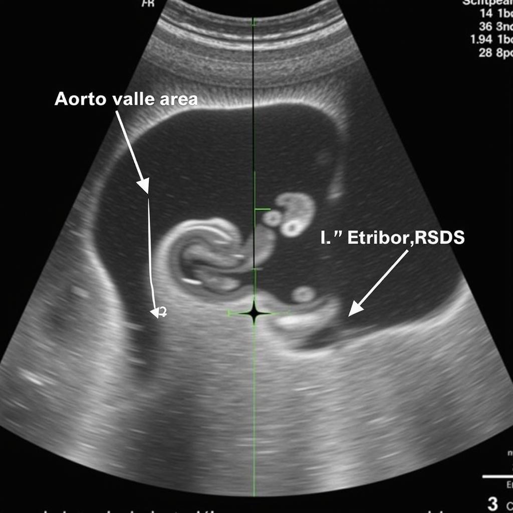 Echocardiography for Aortic Stenosis